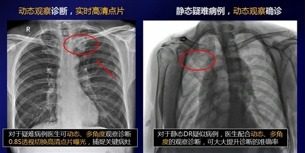 動(dòng)态DR咊(he)靜态DR圖像對比